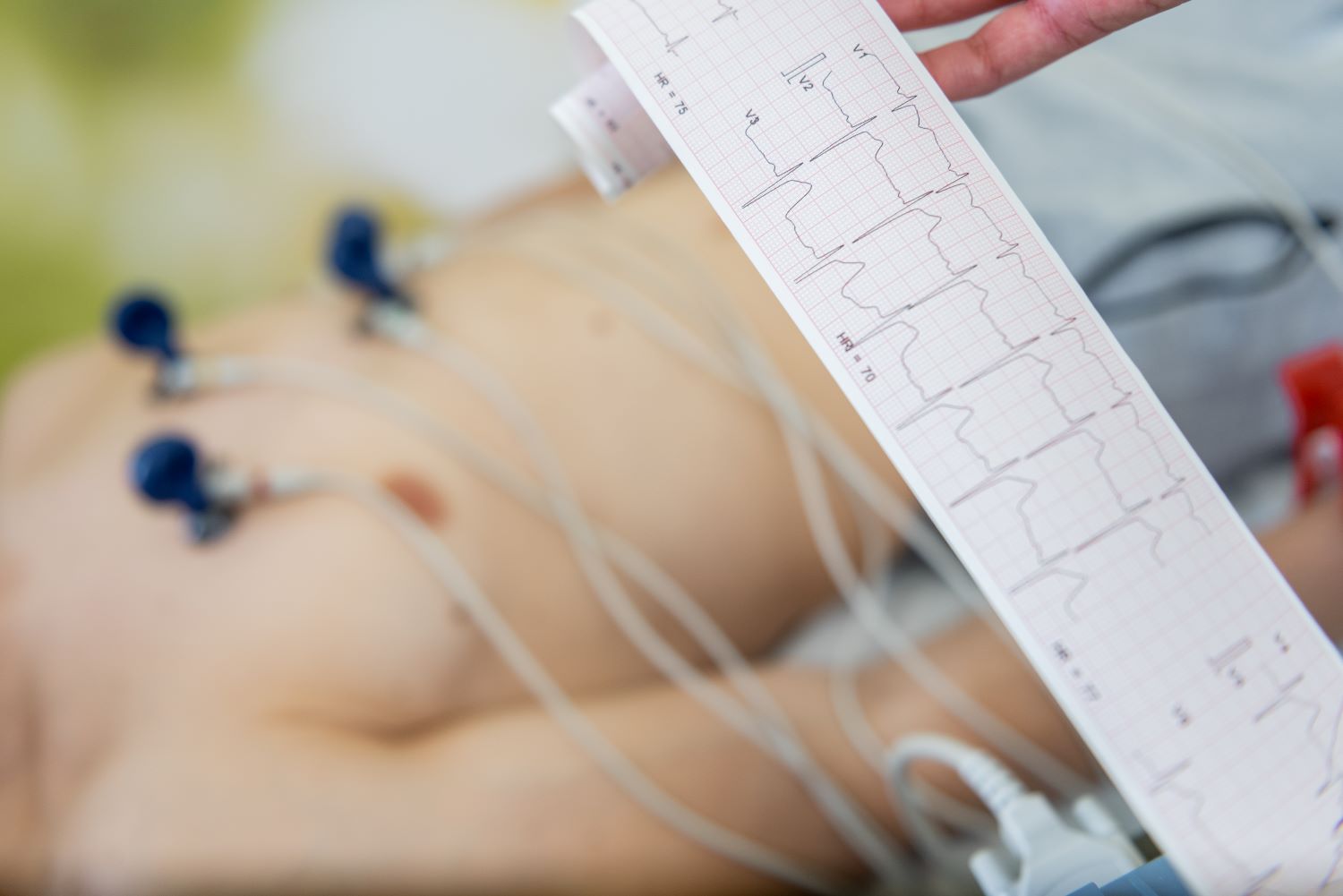 Resting ECG