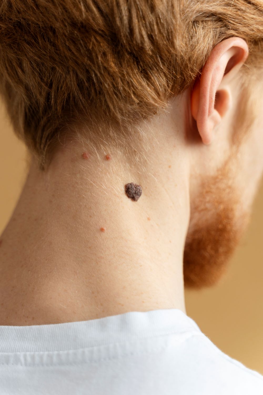 Mole mapping